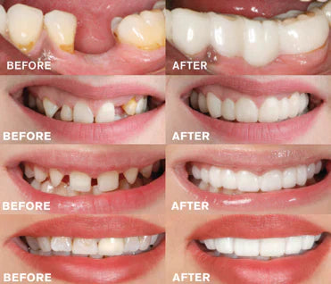 BrightDent SnapFit – Transform your smile with stunning aesthetic dental veneers